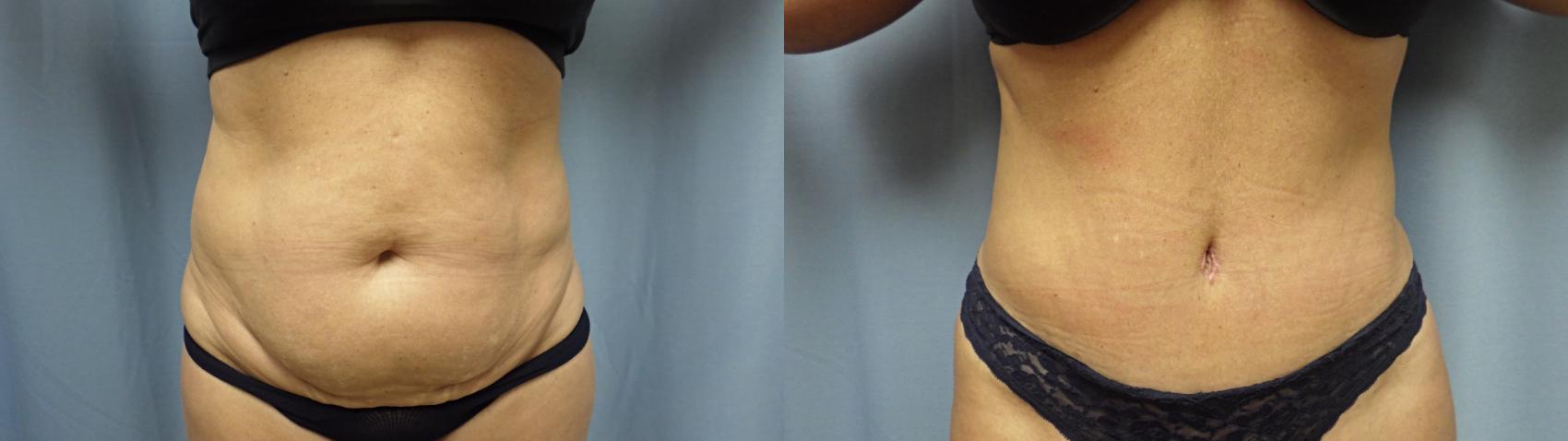 Abdominoplasty/Tummy Tuck Before & After Photo | Atlanta, GA | Plastic Surgery Center of the South