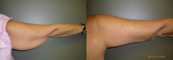 Armlift Before & After Photo | Atlanta, GA | Plastic Surgery Center of the South