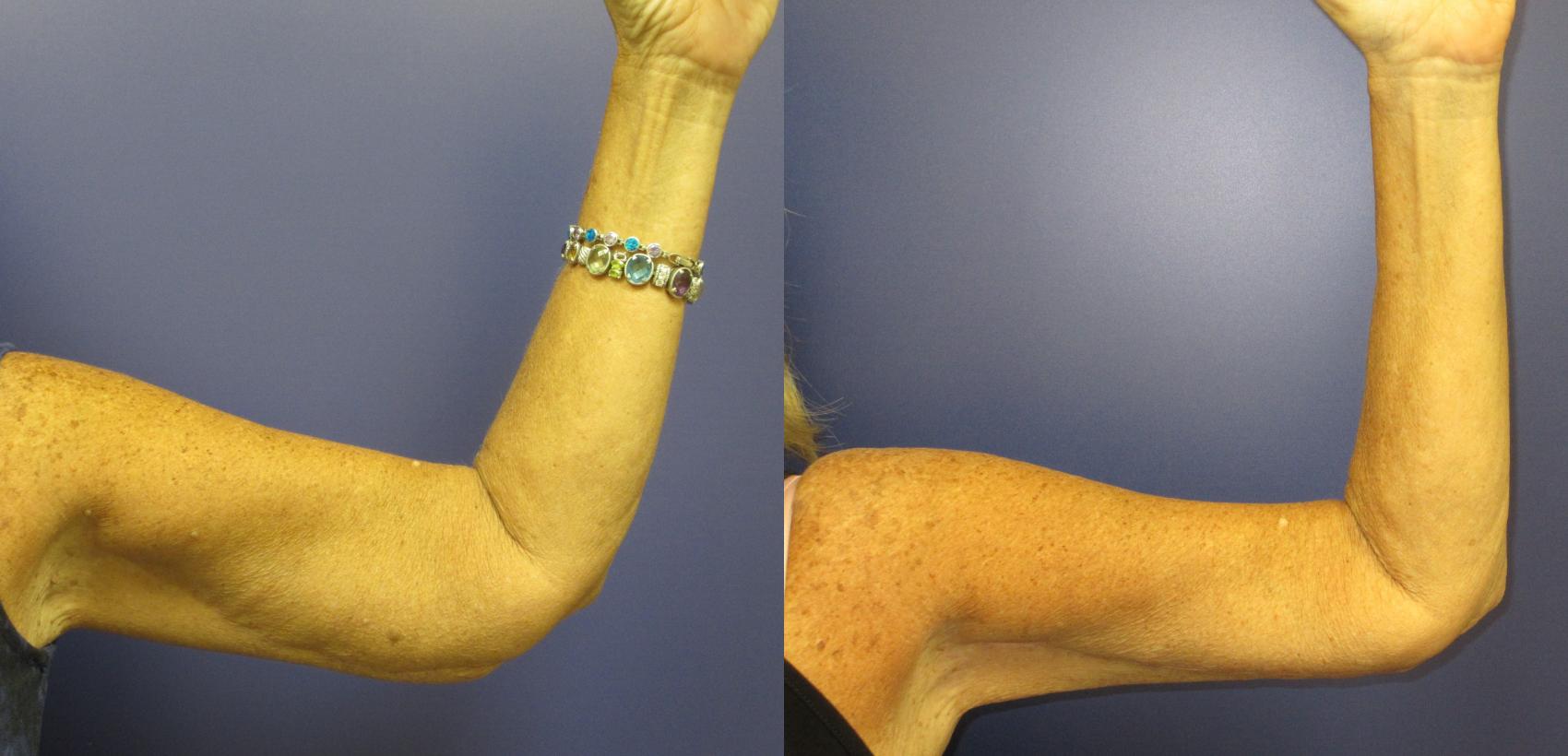 Armlift Before & After Photo | Atlanta, GA | Plastic Surgery Center of the South
