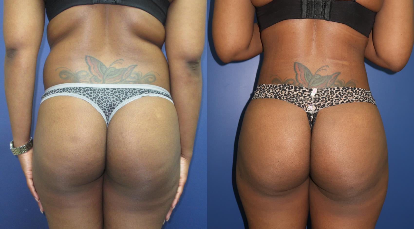 Brazilian Butt Lift Before & After Photo | Atlanta, GA | Plastic Surgery Center of the South