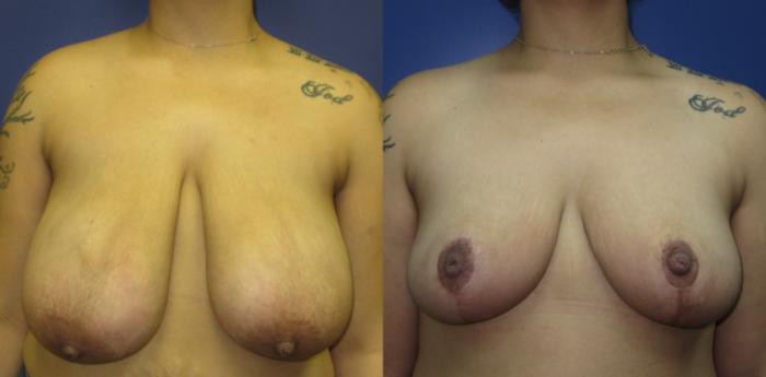 Breast Reduction Before & After Photo | Marietta, GA | Plastic Surgery Center of the South