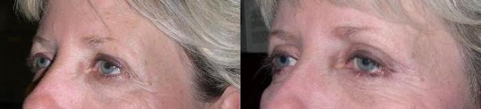 CO2 Laser (Skin Resurfacing) Before & After Photo | Atlanta, GA | Plastic Surgery Center of the South