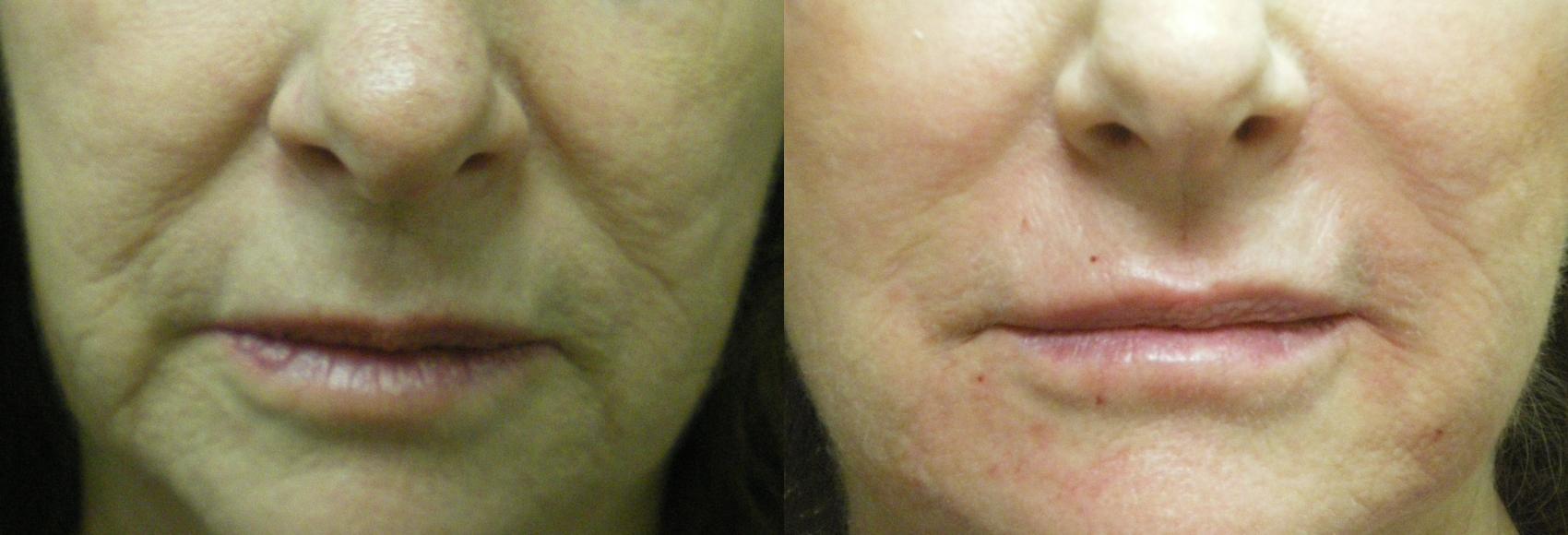 Dermal Fillers Before & After Photo | Atlanta, GA | Plastic Surgery Center of the South