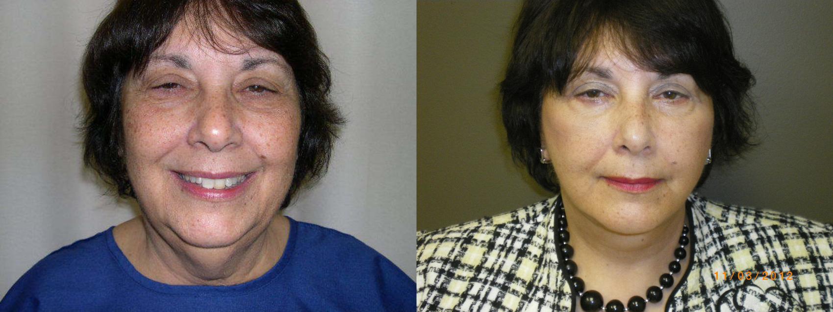 Facelift Before & After Photo | Atlanta, GA | Plastic Surgery Center of the South