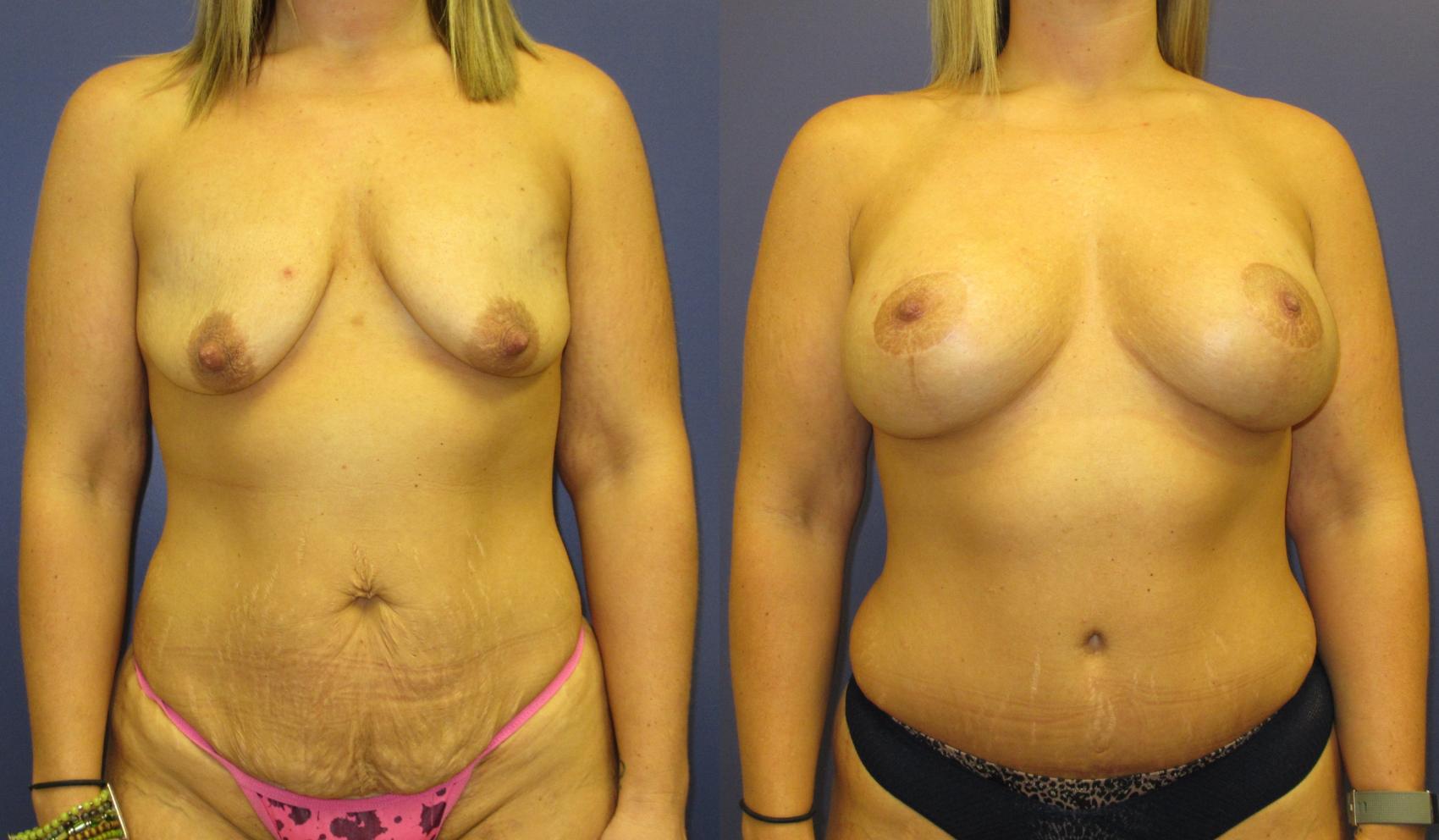 Mommy Makeover Before & After Photo | Atlanta, GA | Plastic Surgery Center of the South