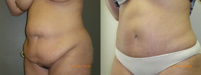 Abdominoplasty/Tummy Tuck Before & After Photo | Atlanta, GA | Plastic Surgery Center of the South