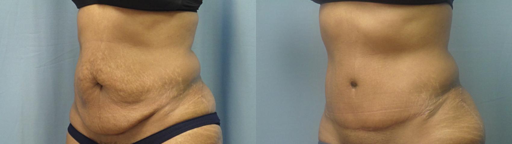 Abdominoplasty/Tummy Tuck Before & After Photo | Atlanta, GA | Plastic Surgery Center of the South