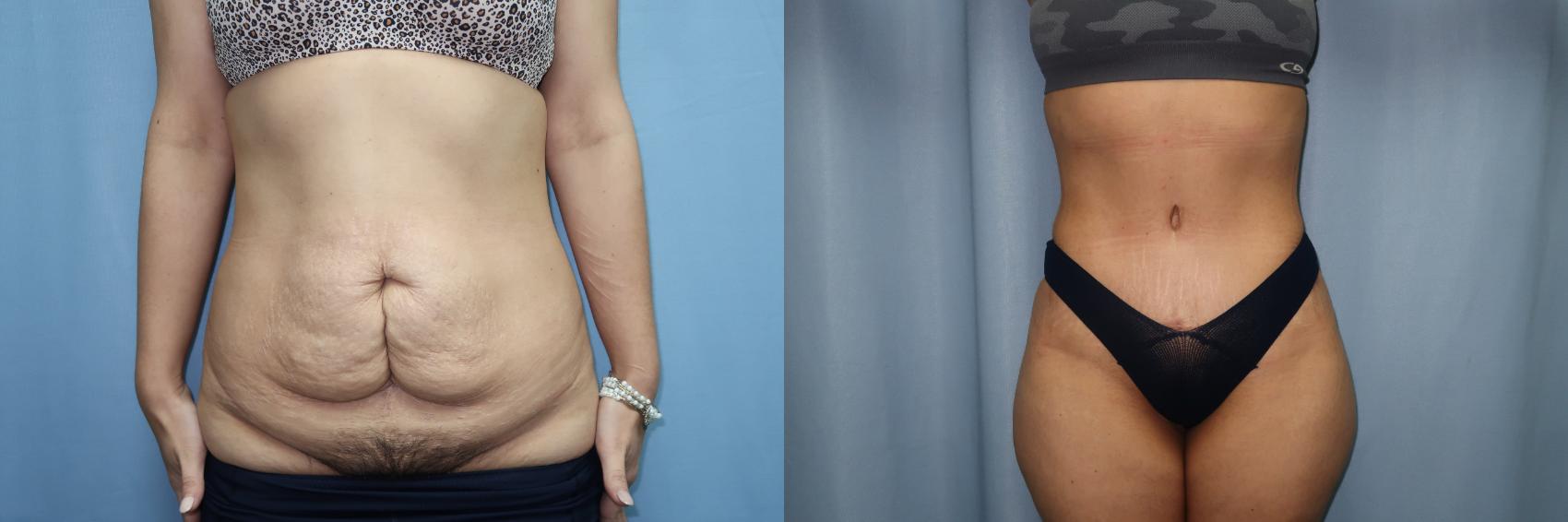 Abdominoplasty/Tummy Tuck Before & After Photo | Marietta, GA | Plastic Surgery Center of the South