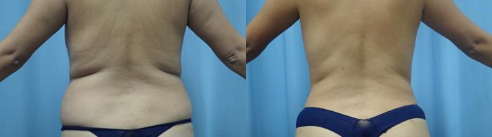 Abdominoplasty/Tummy Tuck Before & After Photo | Marietta, GA | Plastic Surgery Center of the South