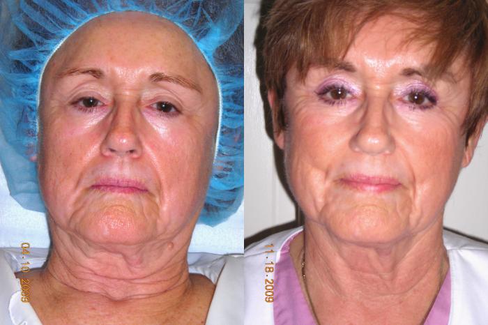 Affirm (Skin Tightening) Before & After Photo | Atlanta, GA | Plastic Surgery Center of the South