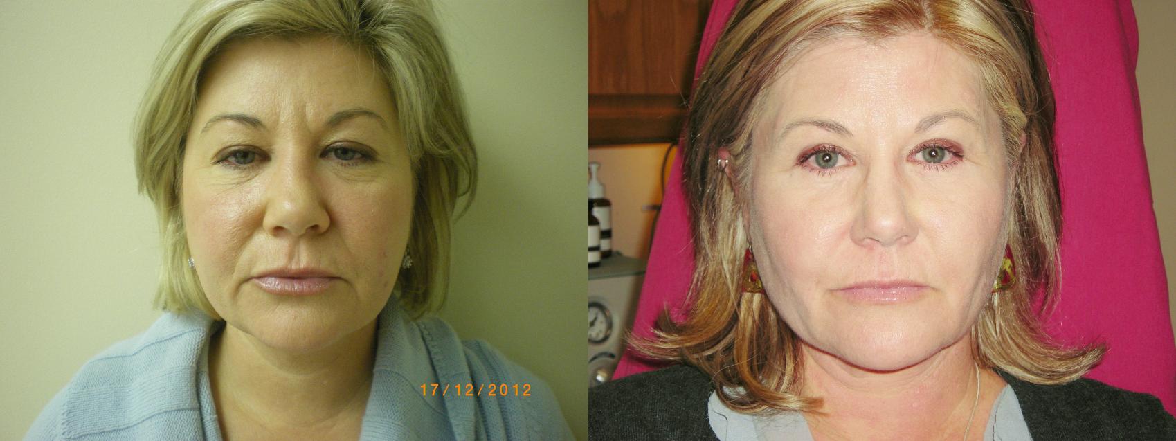 Affirm (Skin Tightening) Before & After Photo | Marietta, GA | Plastic Surgery Center of the South