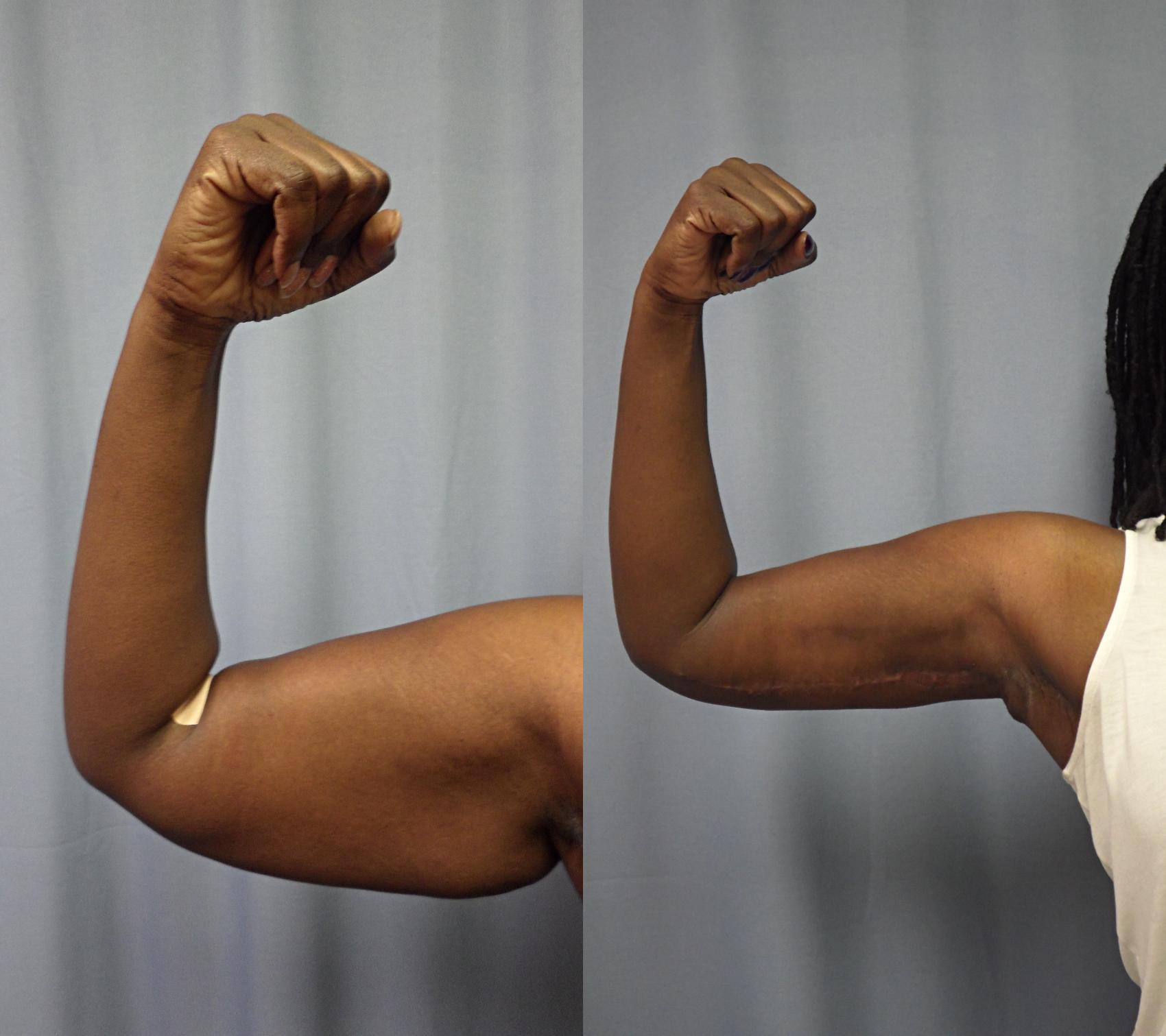 Armlift Before & After Photo | Marietta, GA | Plastic Surgery Center of the South