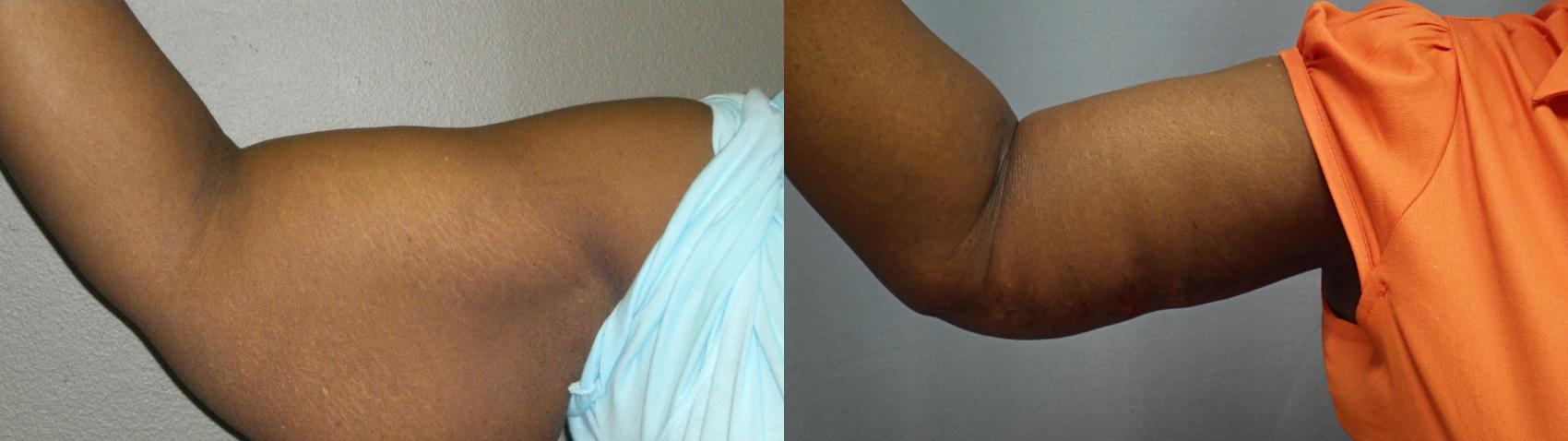 Armlift Before & After Photo | Marietta, GA | Plastic Surgery Center of the South