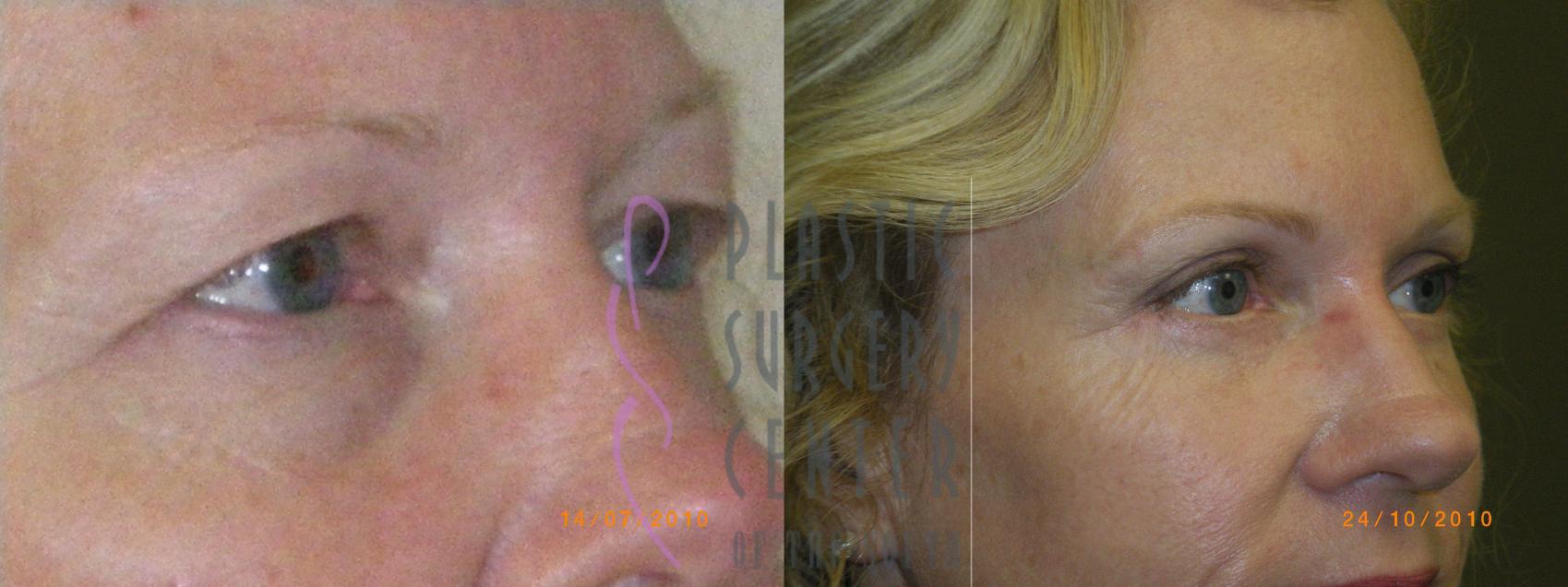 Blepharoplasty (Eyelid) Before & After Photo | Atlanta, GA | Plastic Surgery Center of the South