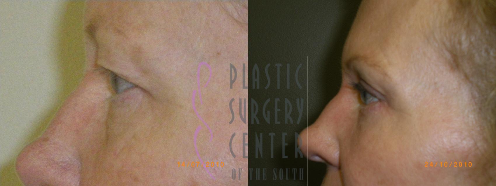 Blepharoplasty (Eyelid) Before & After Photo | Atlanta, GA | Plastic Surgery Center of the South