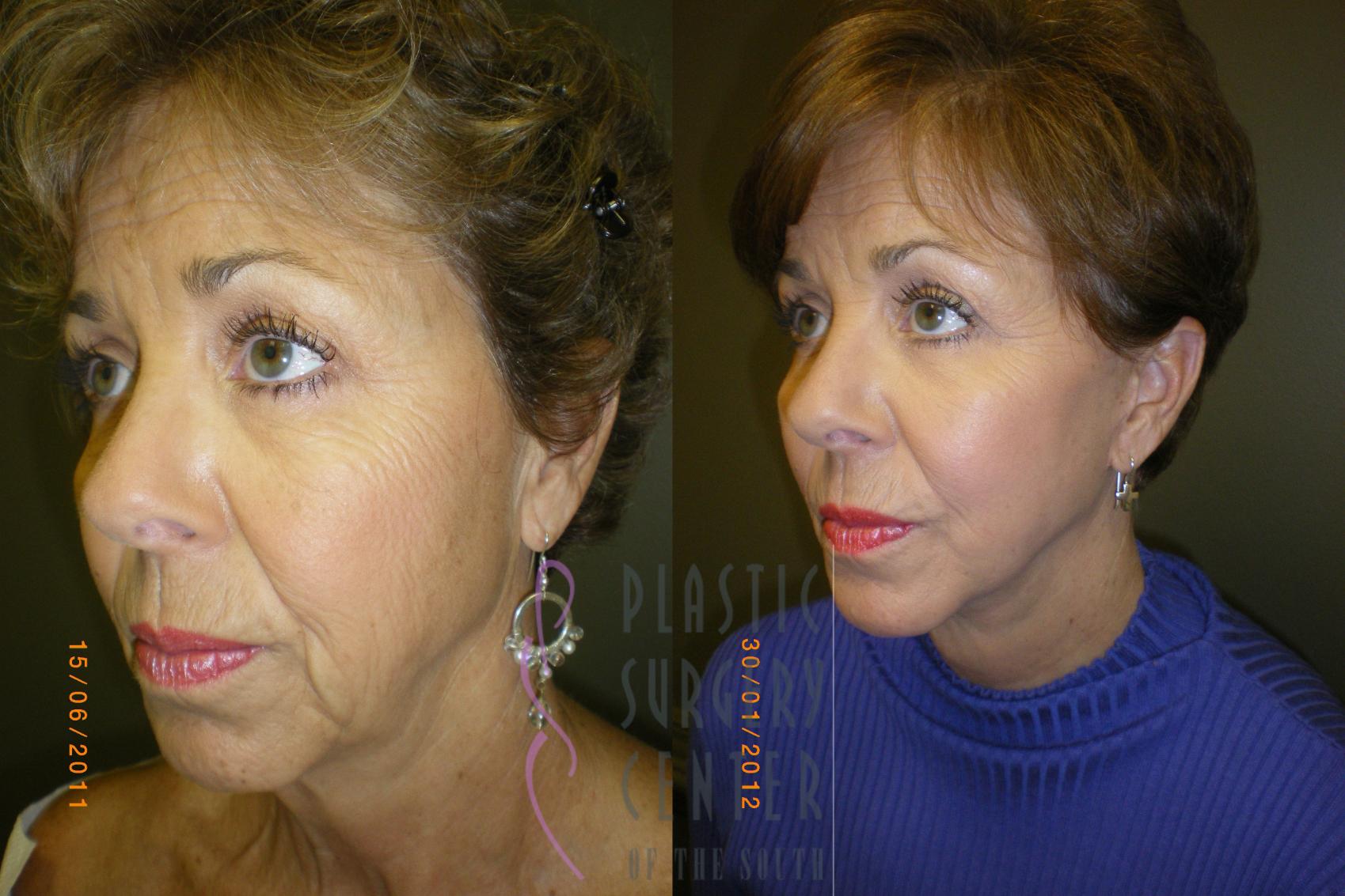Blepharoplasty (Eyelid) Before & After Photo | Atlanta, GA | Plastic Surgery Center of the South