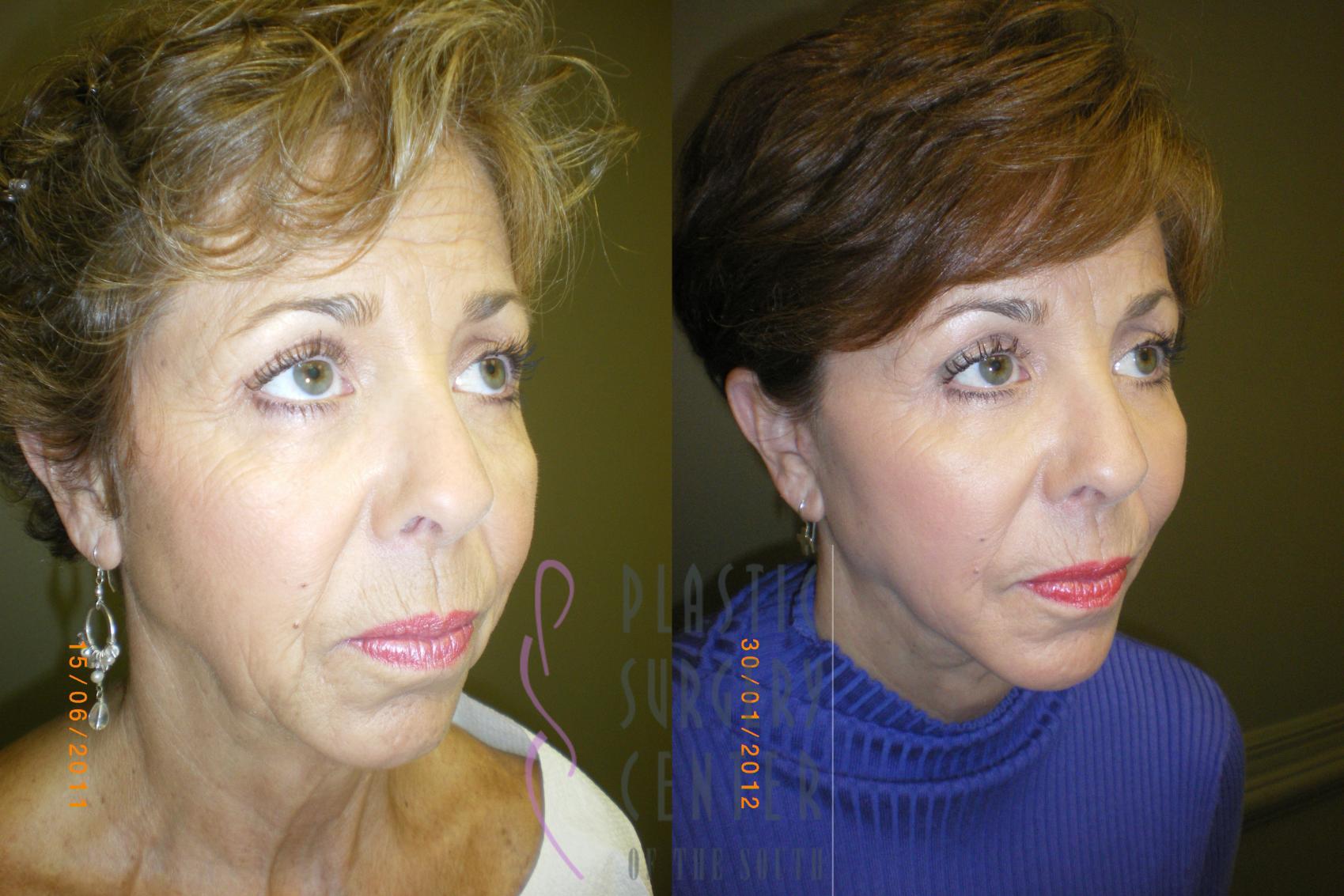 Blepharoplasty (Eyelid) Before & After Photo | Atlanta, GA | Plastic Surgery Center of the South