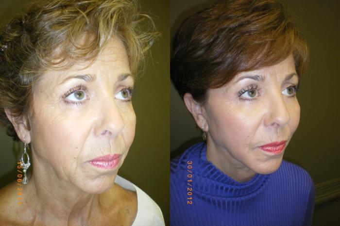 Blepharoplasty (Eyelid) Before & After Photo | Marietta, GA | Plastic Surgery Center of the South
