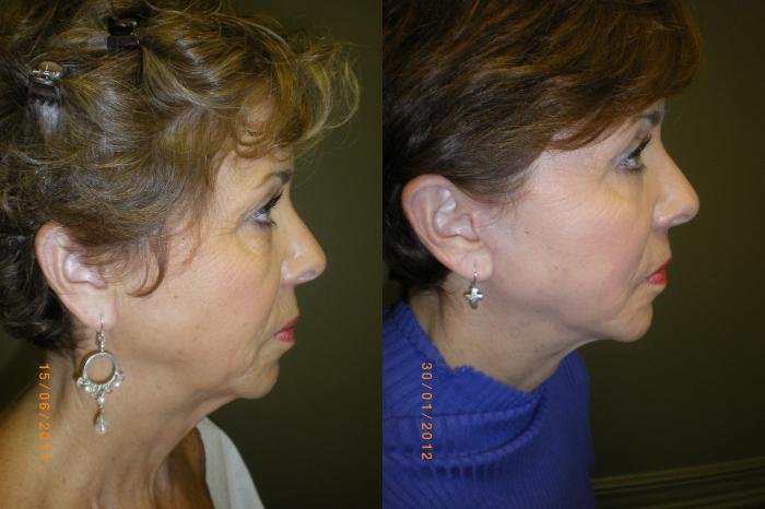 Blepharoplasty (Eyelid) Before & After Photo | Marietta, GA | Plastic Surgery Center of the South