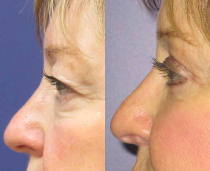 Blepharoplasty (Eyelid) Before & After Photo | Atlanta, GA | Plastic Surgery Center of the South