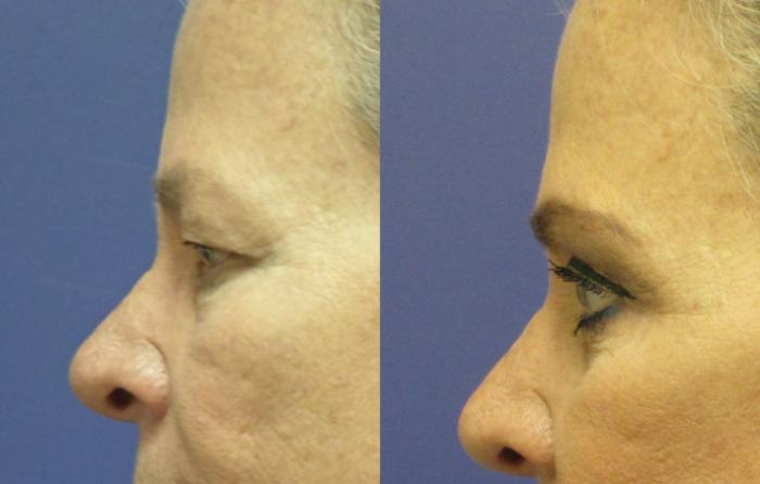 Blepharoplasty (Eyelid) Before & After Photo | Atlanta, GA | Plastic Surgery Center of the South