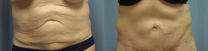 Body Lift Before & After Photo | Atlanta, GA | Plastic Surgery Center of the South