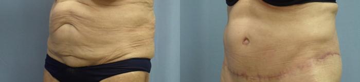 Body Lift Before & After Photo | Atlanta, GA | Plastic Surgery Center of the South