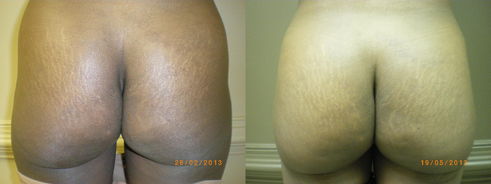Brazilian Butt Lift Before & After Photo | Marietta, GA | Plastic Surgery Center of the South