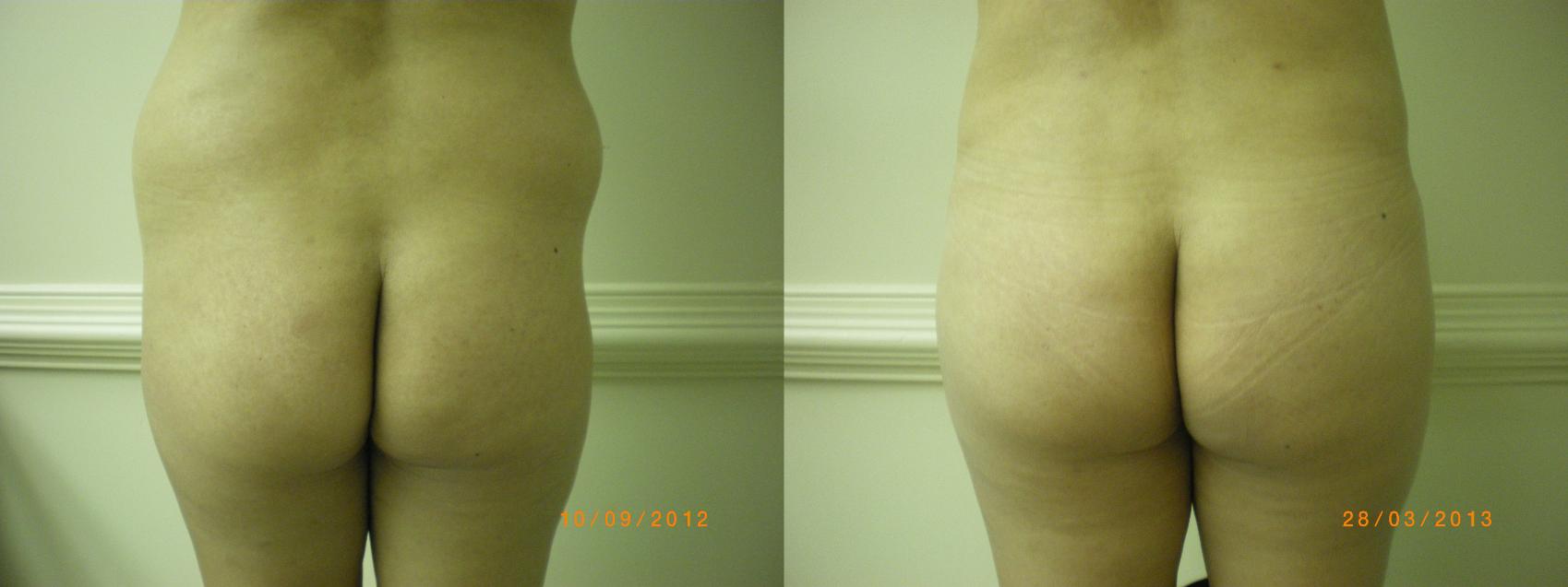 Brazilian Butt Lift Before & After Photo | Marietta, GA | Plastic Surgery Center of the South