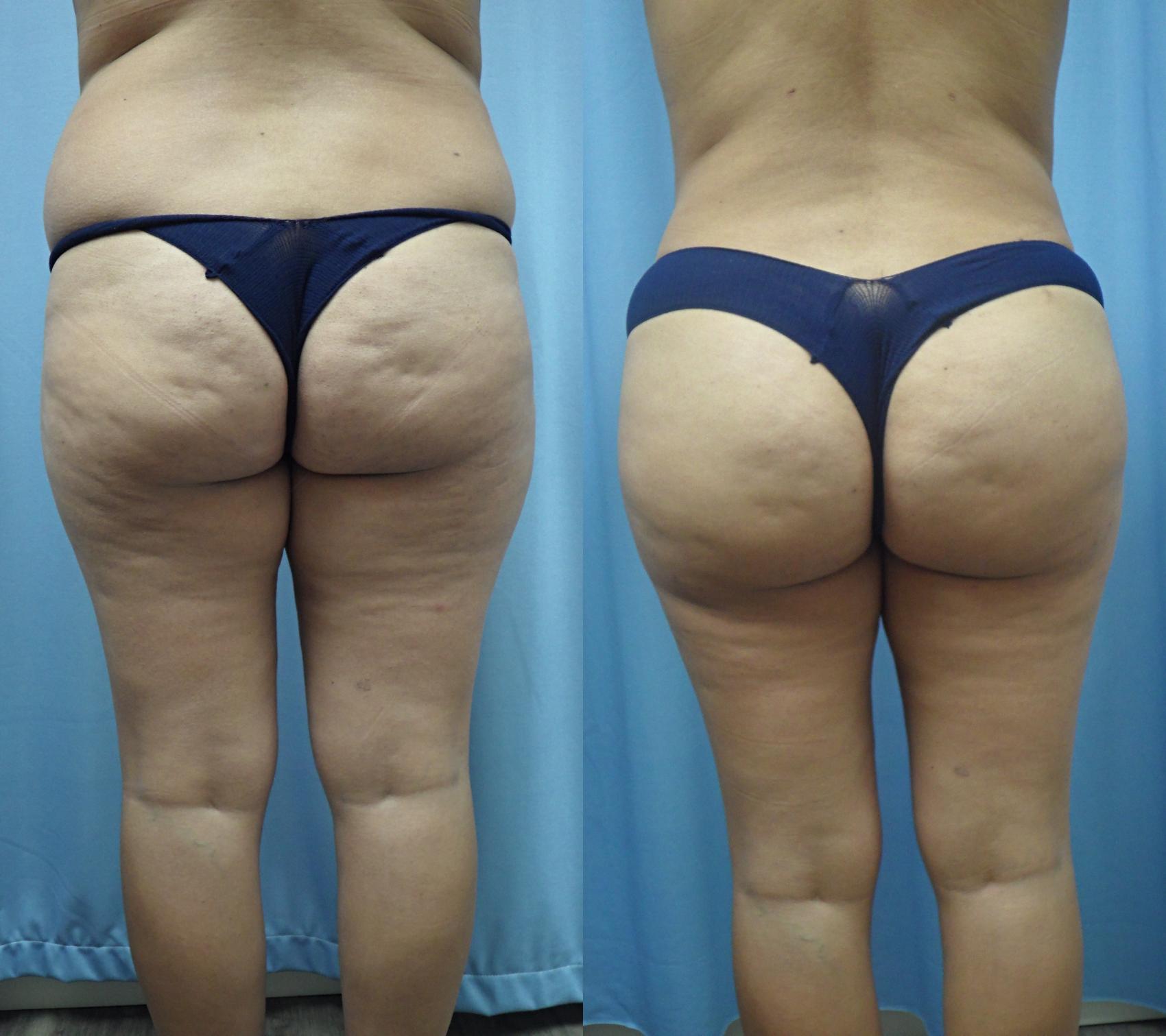 Buttock enhancement - Cosmetic Plastic Surgery Institute