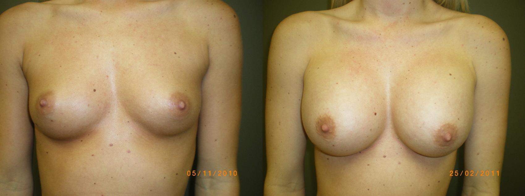 Breast Augmentation Before & After Photo | Atlanta, GA | Plastic Surgery Center of the South