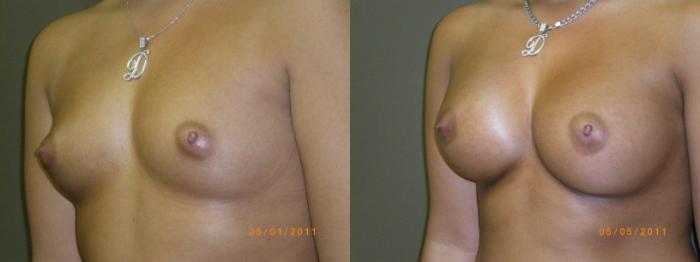 Breast Augmentation Before & After Photo | Marietta, GA | Plastic Surgery Center of the South