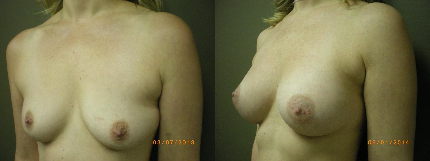 Breast Augmentation Before & After Photo | Atlanta, GA | Plastic Surgery Center of the South