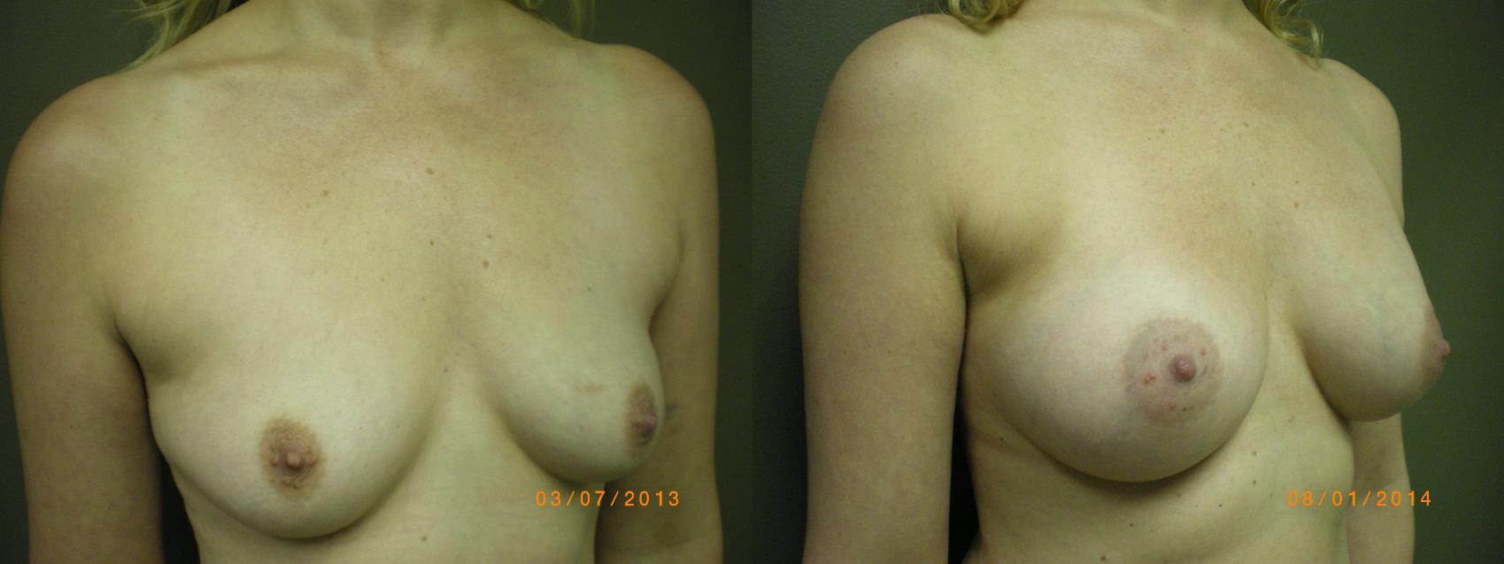 Breast Augmentation Before & After Photo | Atlanta, GA | Plastic Surgery Center of the South