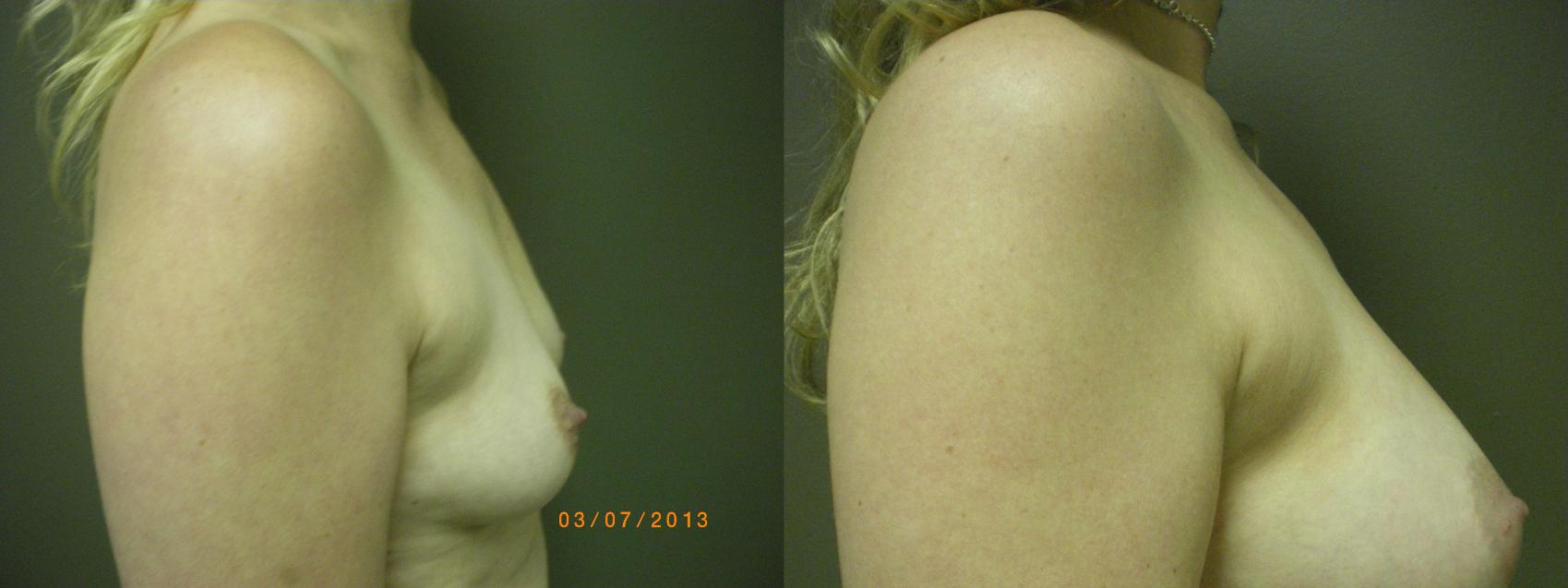 Breast Augmentation Before & After Photo | Atlanta, GA | Plastic Surgery Center of the South