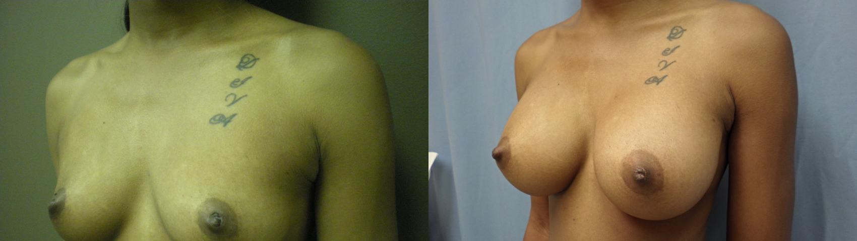 Breast Augmentation Before & After Photo | Atlanta, GA | Plastic Surgery Center of the South