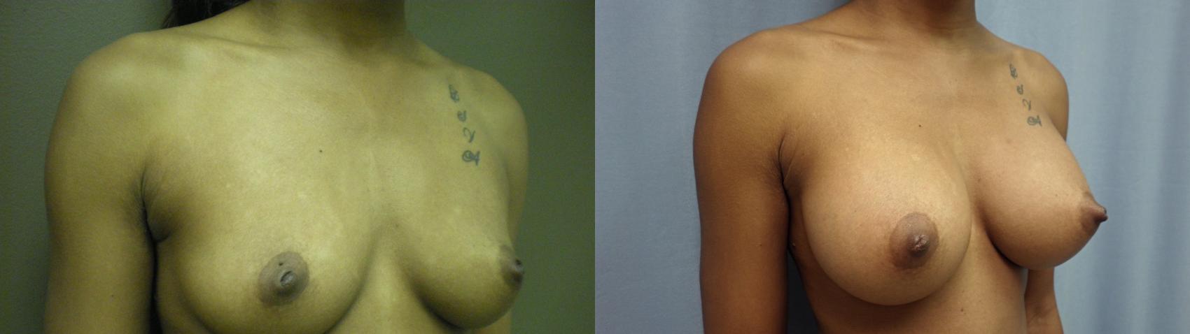 Breast Augmentation Before & After Photo | Atlanta, GA | Plastic Surgery Center of the South