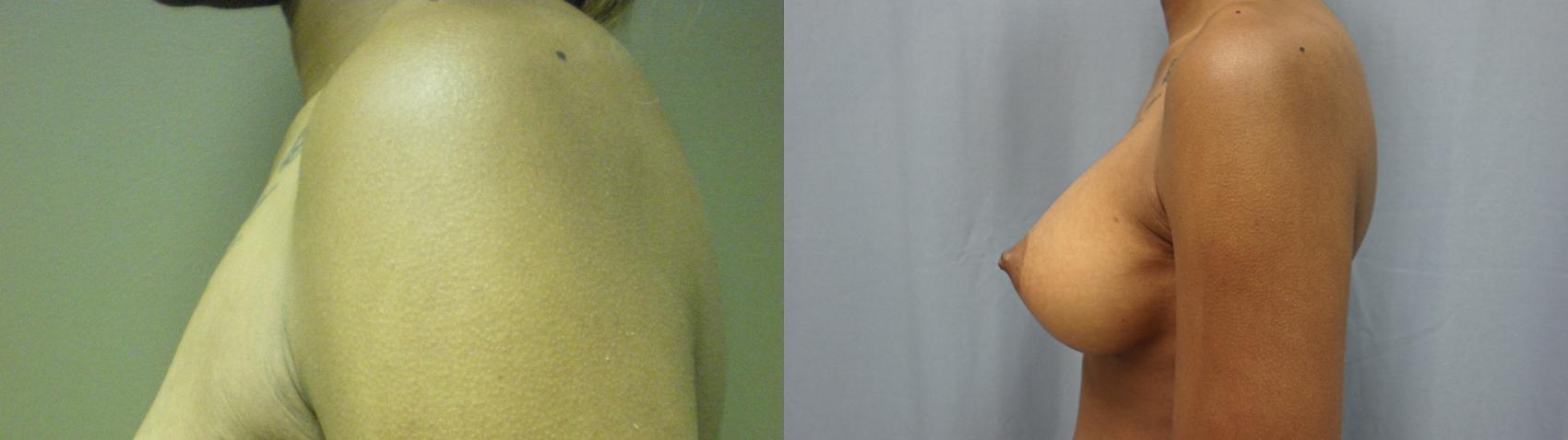 Breast Augmentation Before & After Photo | Atlanta, GA | Plastic Surgery Center of the South