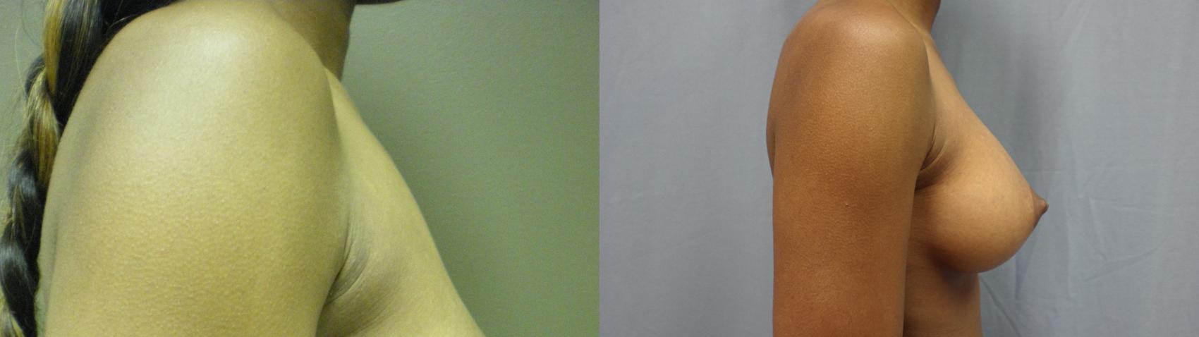 Breast Augmentation Before & After Photo | Atlanta, GA | Plastic Surgery Center of the South