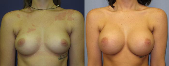 Breast Augmentation Before & After Photo | Marietta, GA | Plastic Surgery Center of the South