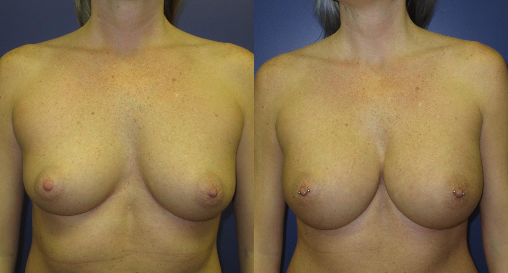 Breast Augmentation Before & After Photo | Atlanta, GA | Plastic Surgery Center of the South