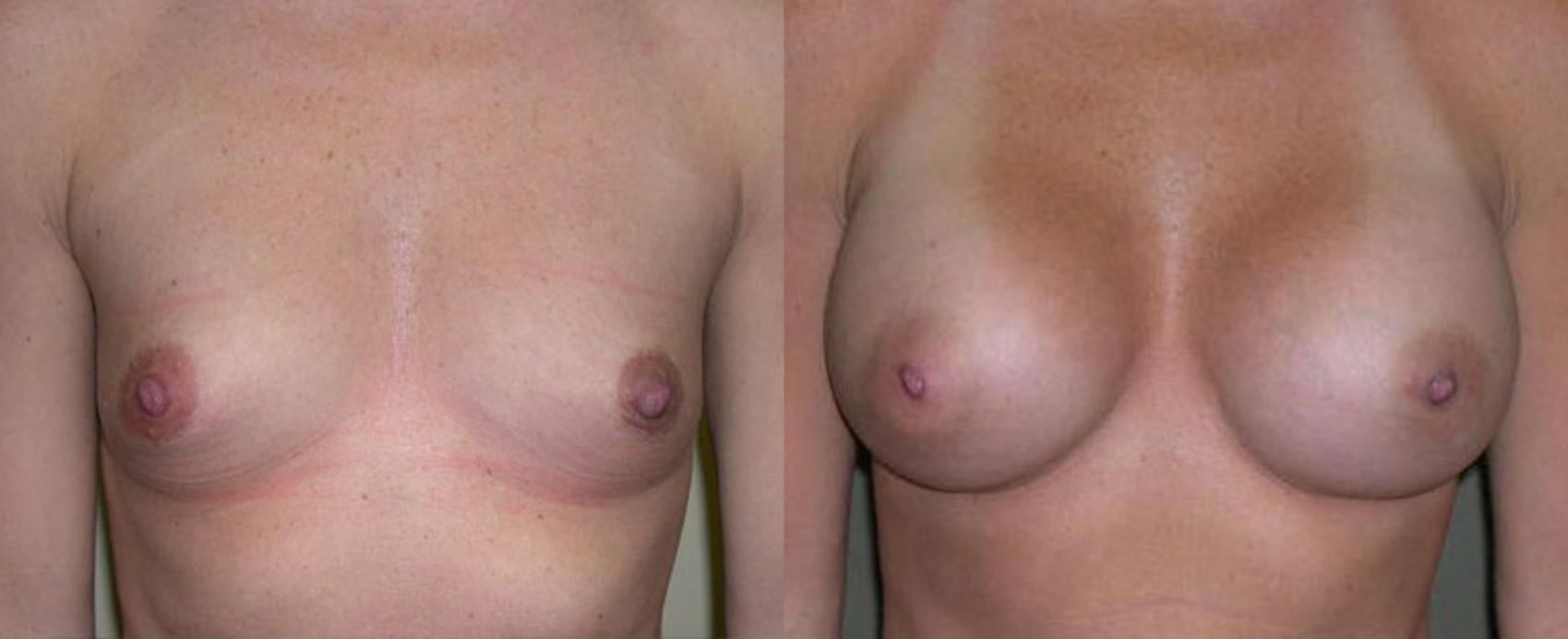 Breast Augmentation Before & After Photo | Atlanta, GA | Plastic Surgery Center of the South