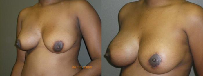 Breast Lift Before & After Photo | Marietta, GA | Plastic Surgery Center of the South