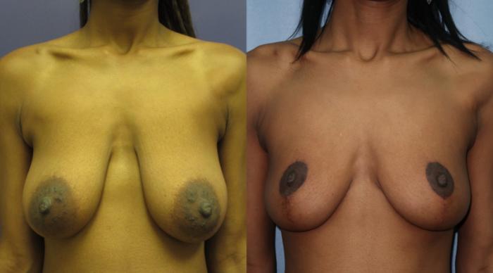 Breast Lift Before & After Photo | Atlanta, GA | Plastic Surgery Center of the South