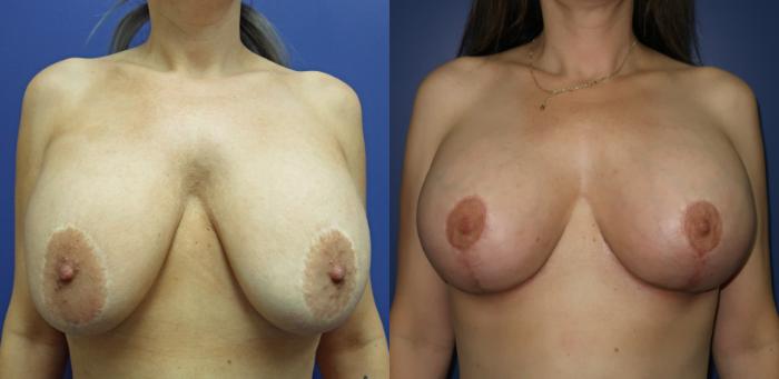 Breast Lift Before & After Photo | Marietta, GA | Plastic Surgery Center of the South