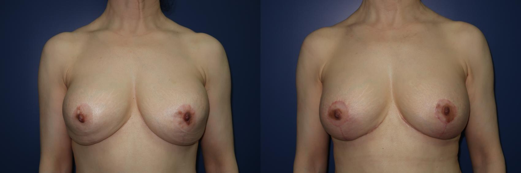 Breast Lift Before & After Photo | Atlanta, GA | Plastic Surgery Center of the South