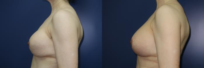 Breast Lift Before & After Photo | Atlanta, GA | Plastic Surgery Center of the South