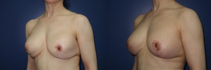 Breast Lift Before & After Photo | Atlanta, GA | Plastic Surgery Center of the South