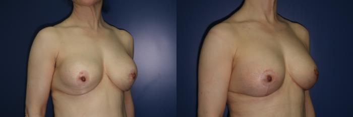 Breast Lift Before & After Photo | Atlanta, GA | Plastic Surgery Center of the South