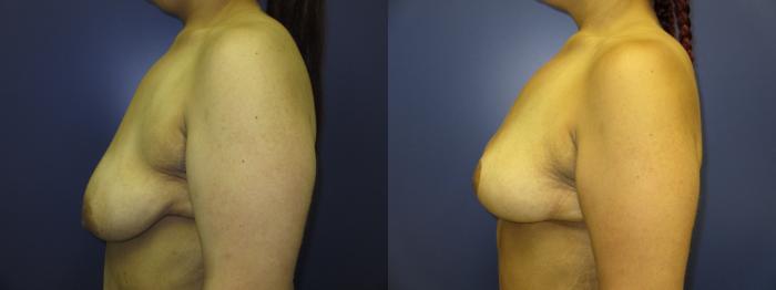 Breast Lift Before & After Photo | Atlanta, GA | Plastic Surgery Center of the South